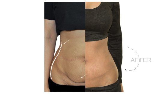 abdominoplasty or tummy tuck amaryllis clinic plastic surgery abu dhabi 2